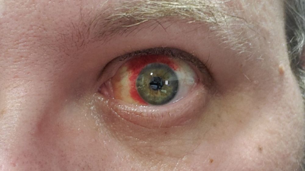My eyeball having a bloody good time.