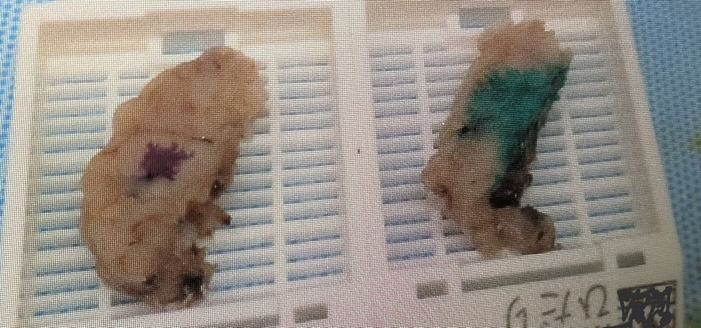 Tonsils right and left