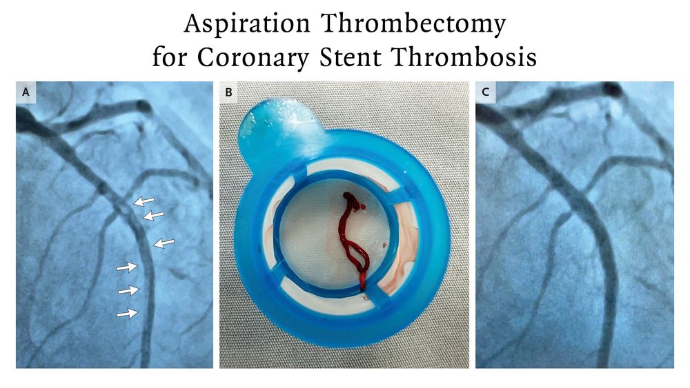 Aspiration Thrombectomy for Coronary Stent Thrombosis 

Panel A: Coronary angiography revealing a large thrombus in the LAD artery stent. 
Panel B: The thrombus that was removed with the use of an aspiration catheter. 
Panel C: The stent that was dilated with a balloon at high pressure, which resulted in improved flow. 