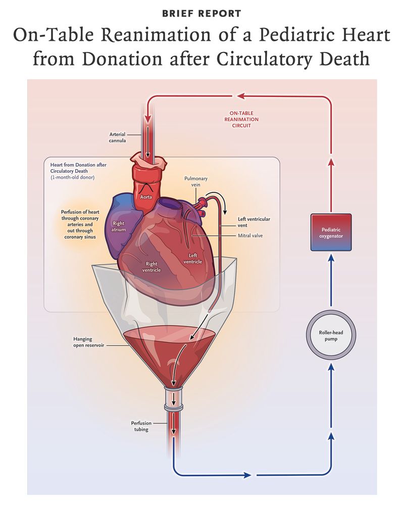 Brief Report 
On-Table Reanimation of a Pediatric Heart from Donation after Circulatory Death 

Illustration of human heart on on-table reanimation circuit with a left ventricular vent in place. 
