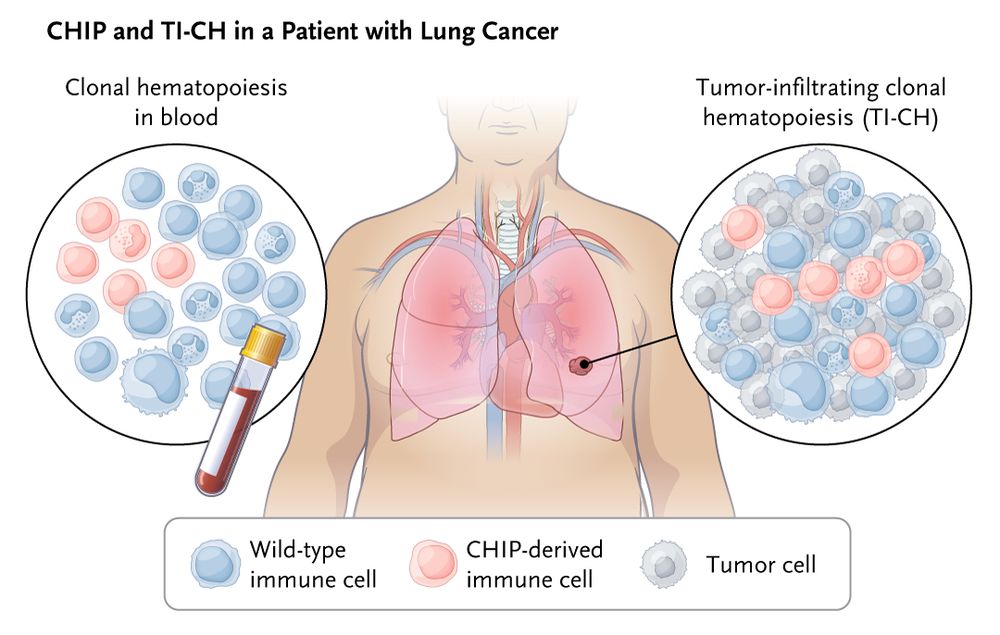 A schematic representation of clonal hematopoiesis of indeterminate potential (CHIP) and tumor-infiltrating clonal hematopoiesis (TI-CH) in a patient with lung cancer. 