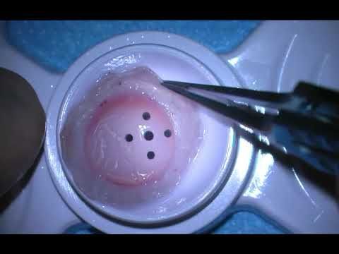 Transplantation of the Entire Bulbar Ocular Surface | NEJM
