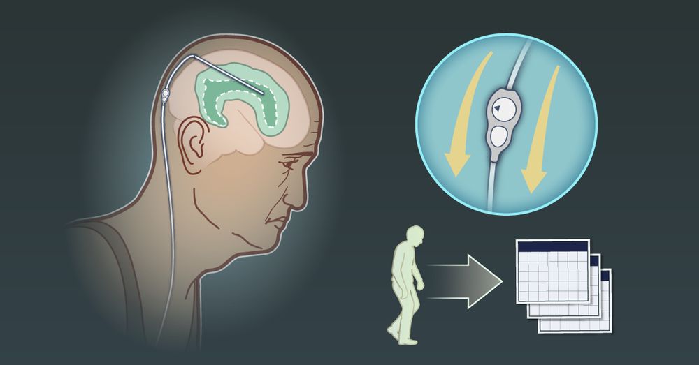 Visual representation of the PENS trial, which evaluated the effectiveness of shunt surgery in patients with idiopathic normal-pressure hydrocephalus. 