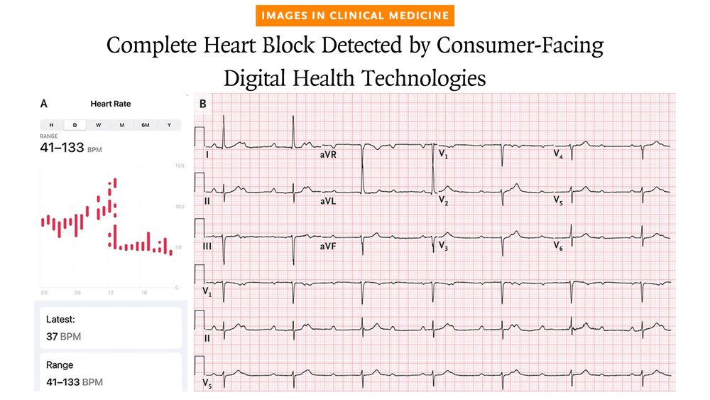 Images in Clinical Medicine 
Complete Heart Block Detected by Consumer-Facing Digital Health Technologies 

Panel A: A review of the heart-rate trend on the patient’s smartwatch showing a sudden decrease in the heart rate at 2 p.m. the day before presentation. 
Panel B: An electrocardiogram showing complete heart block with a junctional escape rhythm. 