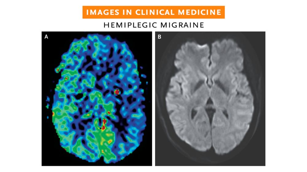 Images in Clinical Medicine 
Hemiplegic Migraine 

Panel A: The MRI sequence measuring cerebral blood flow indicating hypoperfusion of the left hemisphere that did not match vascular territories. 
Panel B: Diffusion-weighted imaging showing no ischemic changes, and angiography showed patent vessels. 