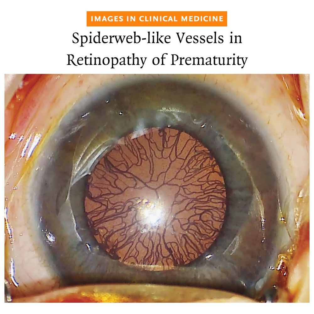 Images in Clinical Medicine 
Spiderweb-like Vessels in Retinopathy of Prematurity 

A photo of one of the patient's eyes with spiderweb-like vessels that densely covered the anterior lens capsule 