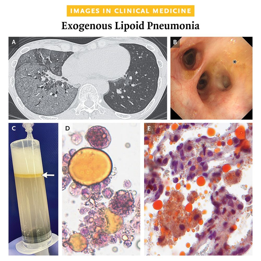 Images in Clinical Medicine
Exogenous Lipoid Pneumonia

Panel A: High-resolution CT of the chest.

Panel B: A photo of yellow secretions observed in the bronchial lumen during bronchoscopy.

Panel C: The secretions separated out in the bronchoalveolar-lavage (BAL) fluid.

Panel D: Cytologic examination of the BAL fluid showing lipid-laden macrophages and extracellular droplets of oil.

Panel E: Histopathological analysis of a lung-biopsy specimen showing numerous macrophages phagocytosing lipid droplets.