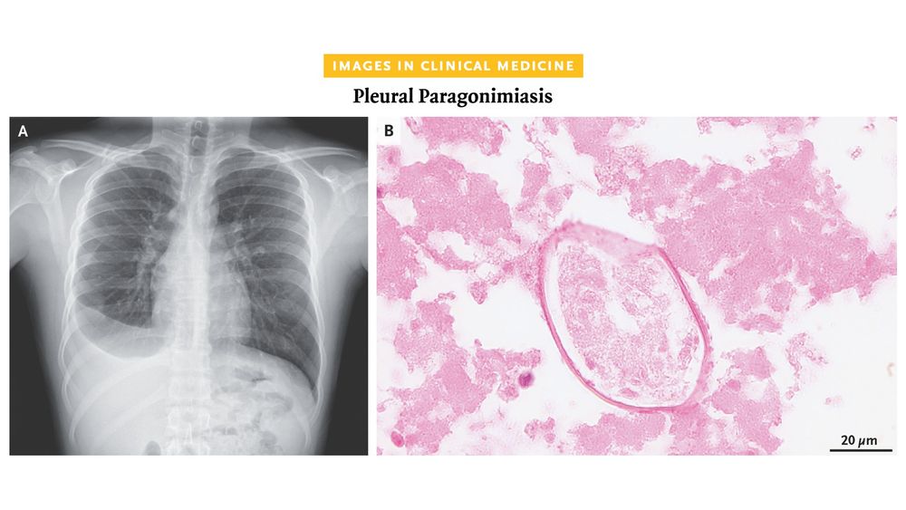 Images in Clinical Medicine
Pleural Paragonimiasis

Panel A: A chest radiograph obtained during a routine assessment at an immigration clinic

Panel B: A small number of parasite eggs seen in the pleural fluid (hematoxylin and eosin staining)