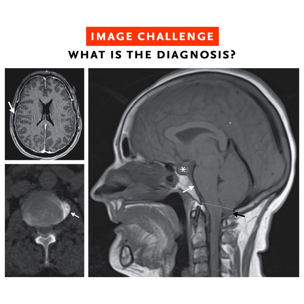 Image Challenge
What is the diagnosis?

Upper left: MRI of the brain showing diffuse pachymeningeal enhancement.
Lower left: A computed tomographic myelogram.
Right: MRI showing protrusion of the cerebellar tonsils into the foramen magnum (tonsillar ectopia), flattening of the pons with effacement of the prepontine cistern, and enlargement of the pituitary gland owing to increased blood flow.