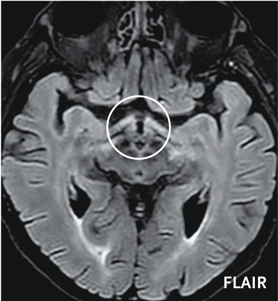 Fluid-attenuated inversion recovery (FLAIR) MRI showing pathological hyperintensity of the chiasm and anterior visual pathway.