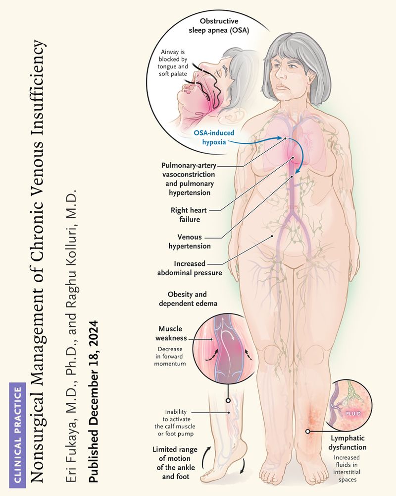 Illustration showing Functional Venous Insufficiency and Venous Hypertension. Along left side of image reads the following:

Clinical Practice

Nonsurgical Management of Chronic Venous Insufficiency

Eri Fukaya, M.D., Ph.D., and Raghu Kolluri, M.D.

Published December 18, 2024