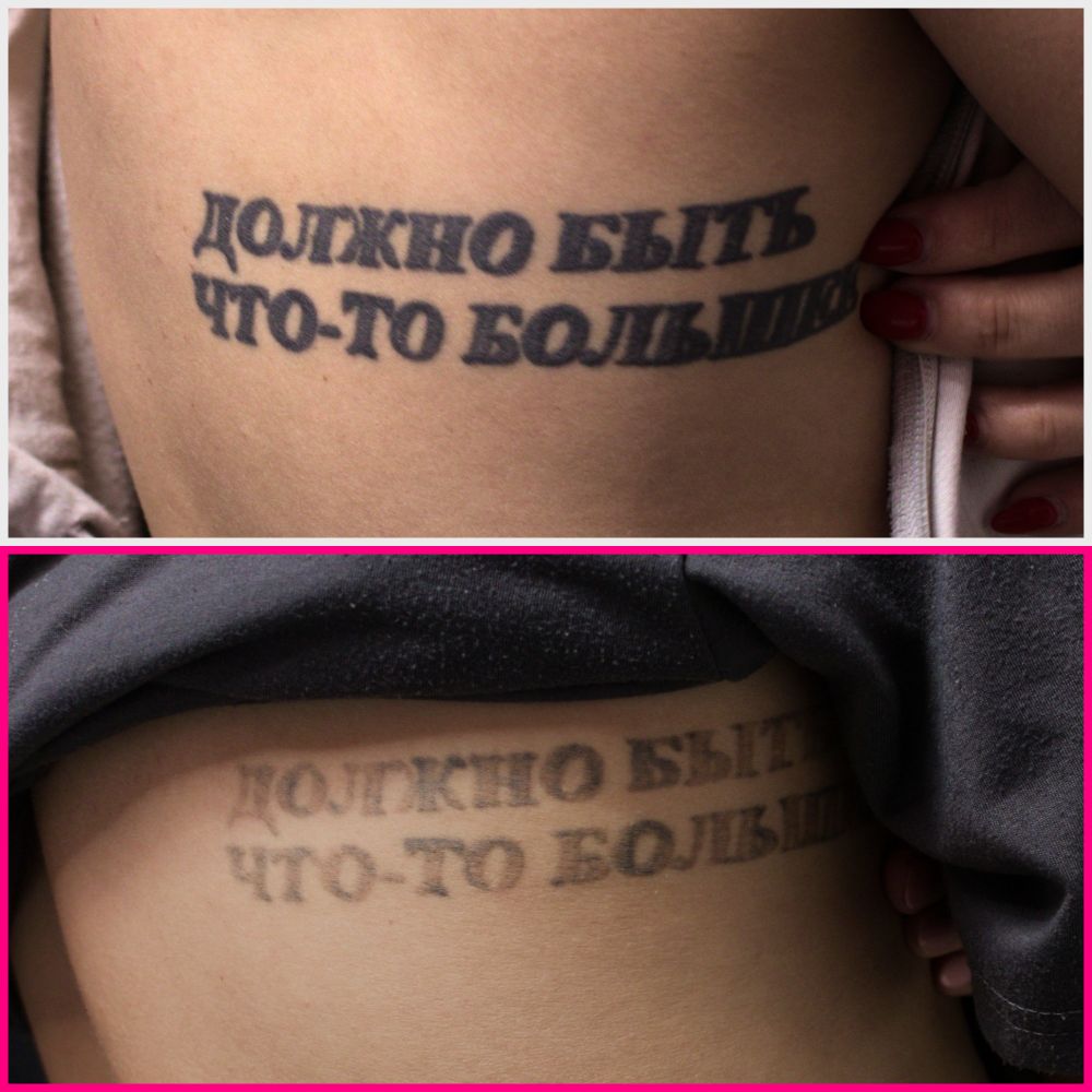 An above/below comparison of the black ink script before any laser tattoo removal treatments (top) and after 2 treatments (bottom)
