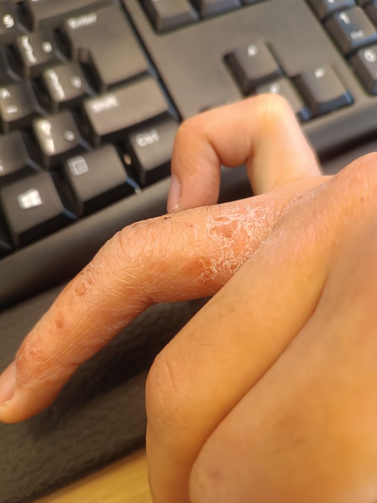 Mão de uma pessoa branca com lesões de dermatite no dedo anelar; as lesões parecem escamas com bordas brancas. Ao fundo da imagem, um teclado preto.