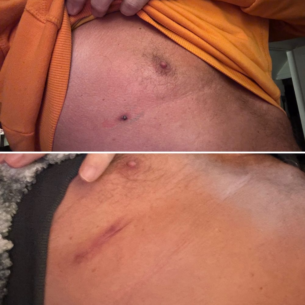Two photos, the top one showing a small mole on my chest that was recently removed and the lower photo showing the resulting scar about 2 weeks after the procedure. 