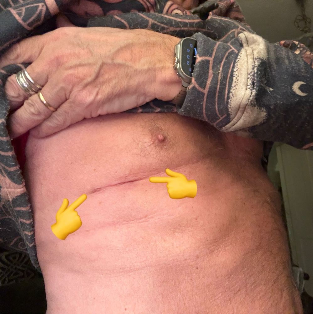 Picture shows a scar (indicated by 2pointing emojis) that is healing well.