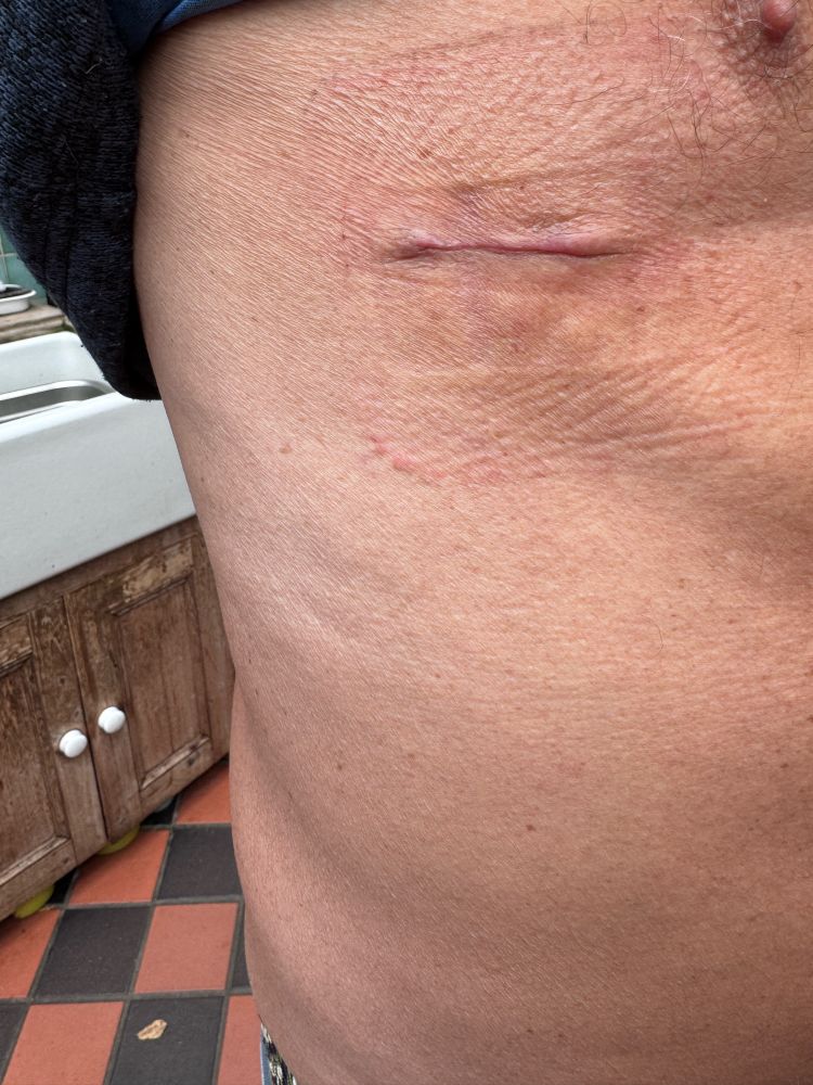 Photo of a scar, taken when the dressing was removed, 6 days after a minor operation to remove a small mole from the side of my chest. 