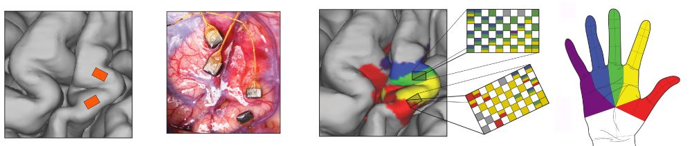 Progression of implant plan from placement map, to surgical image, to stimulation results.