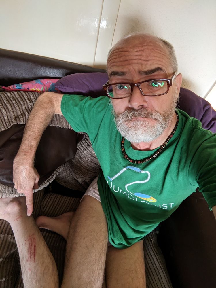 A man pointing at a graze on his leg