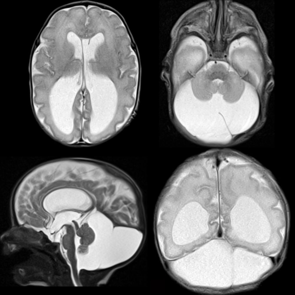 Pediatric Blake Pouch Cyst | Pediatric Radiology Reference Article | Pediatric Imaging | @pedsimaging