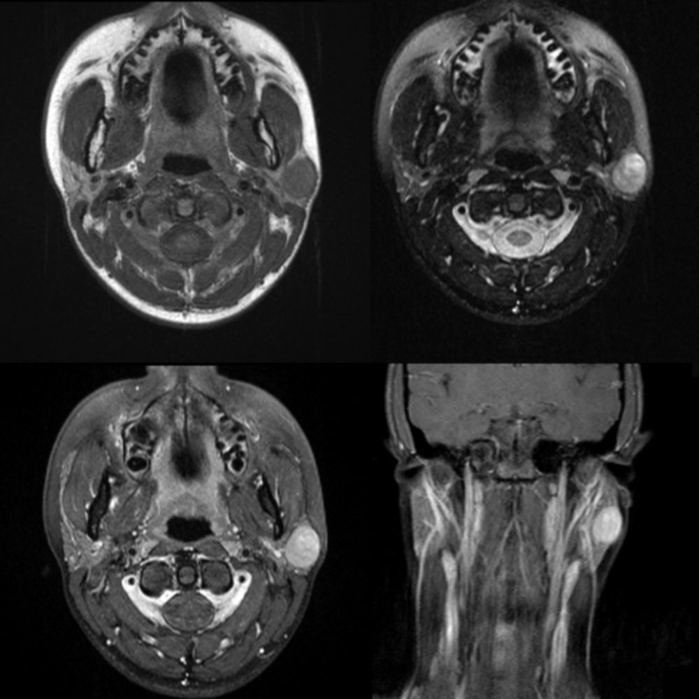 Pediatric Pleomorphic Adenoma | Pediatric Radiology Reference Article | Pediatric Imaging | @pedsimaging