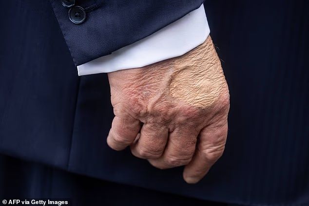 Trump applied makeup to hide bruising