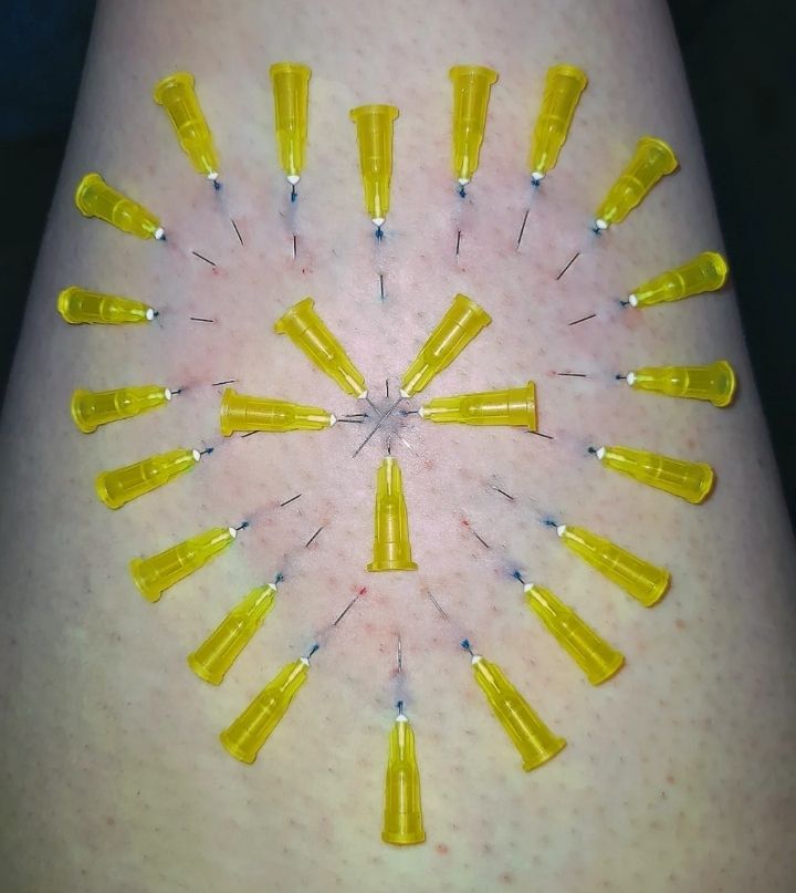 Photo of needle play in a thigh with 30G needles pierced in a heart formation with a star in the middle. 