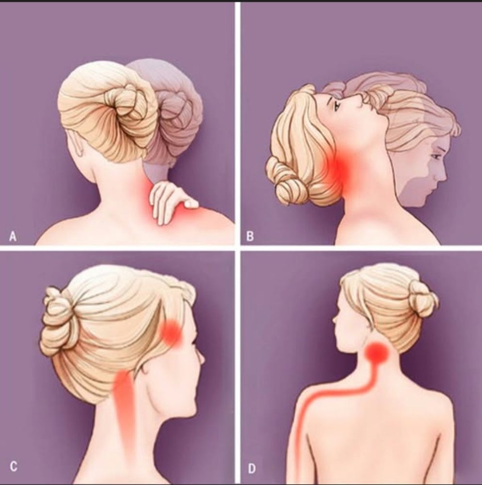 First pic of neck pain and woman rubbing spot; second pic of upper neck pain and woman tilting head back; 3rd pic of upper neck and temple pain; 4th pic of upper neck pain with line going from upper neck down through the shoulder