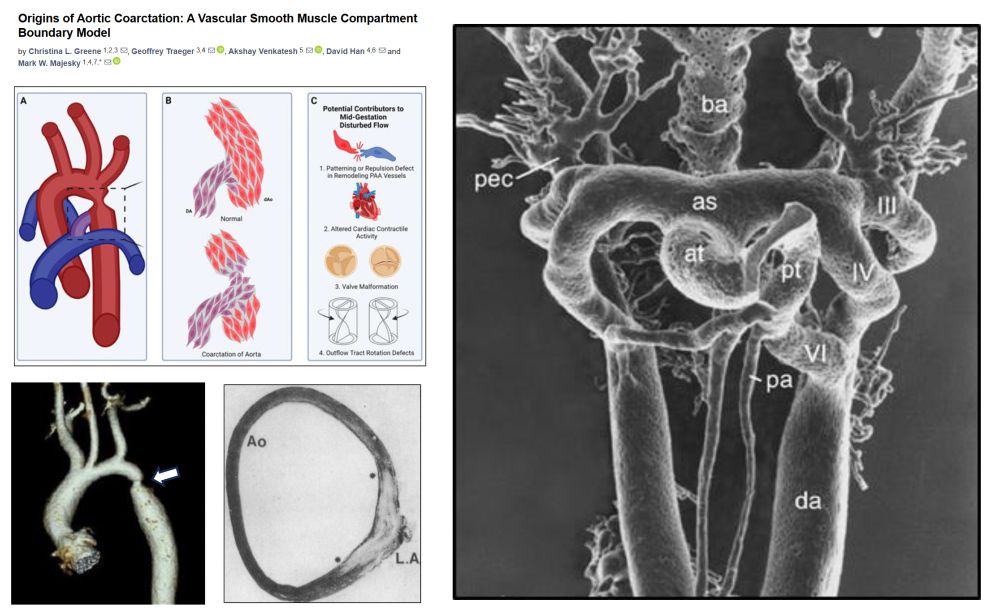 Is CoA a problem because an over-constrictive (flow-sensitive) SMC subpopulation of CNC origin has invaded the aortic zone, which is supposed to be populated by mesodermal SMCs?😁