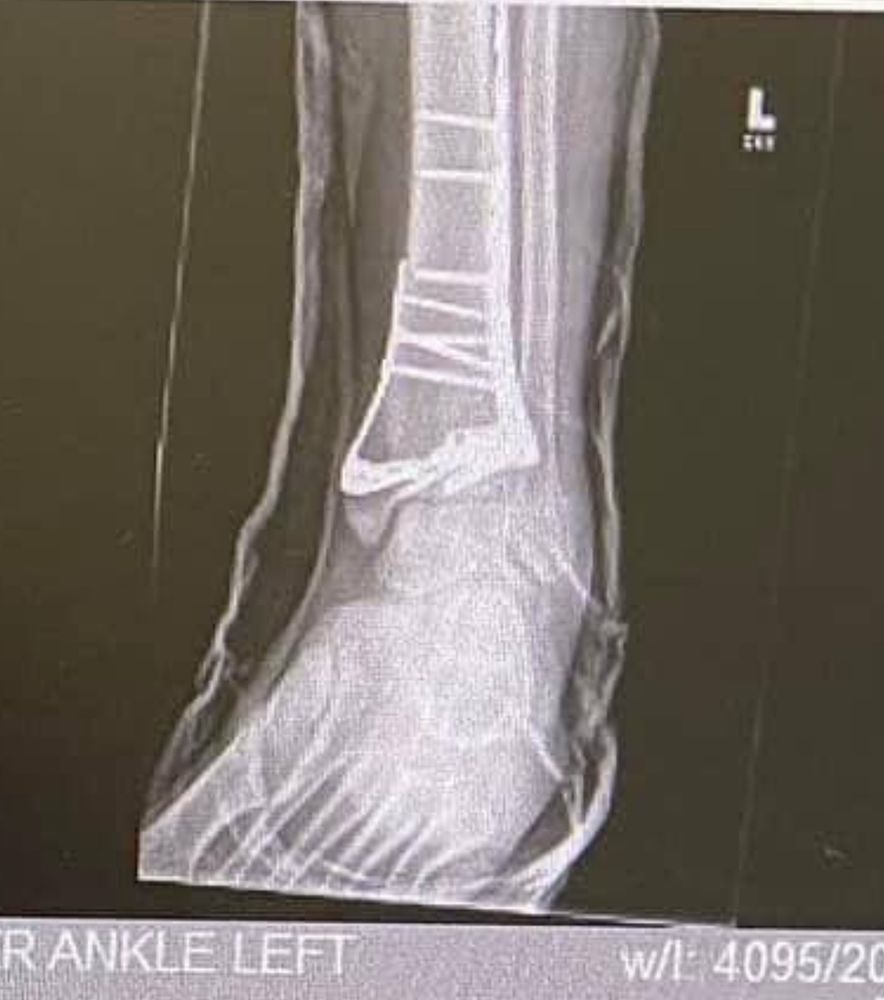 An X-ray of my left ankle showing quite a lot of screws and plates. 