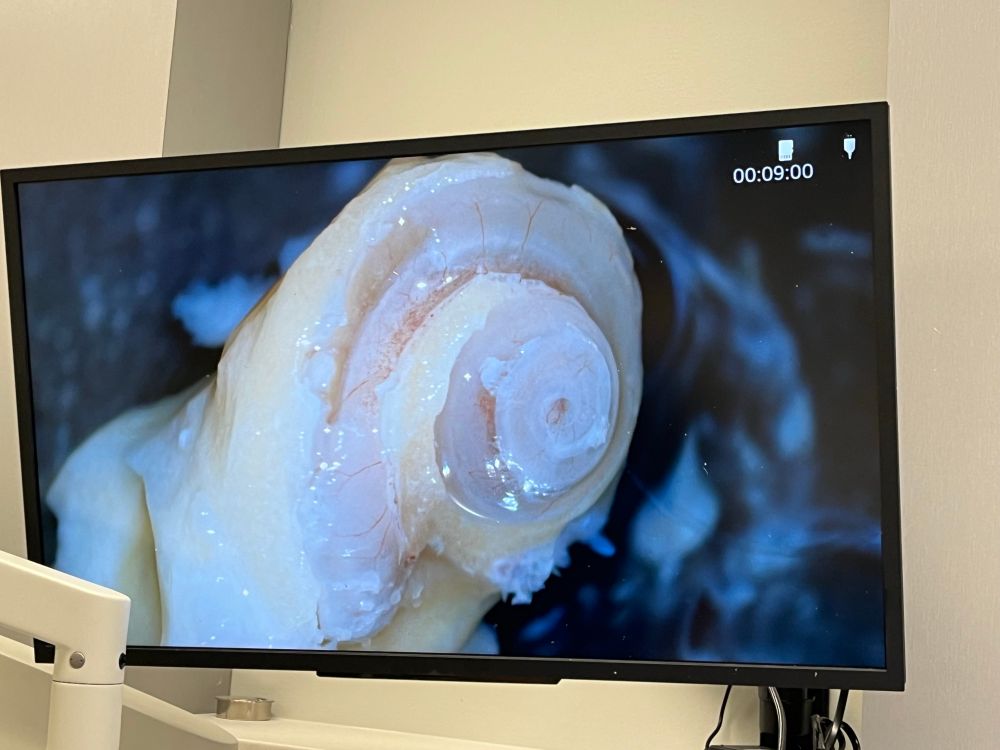 Partial dissection of a human hearing organ