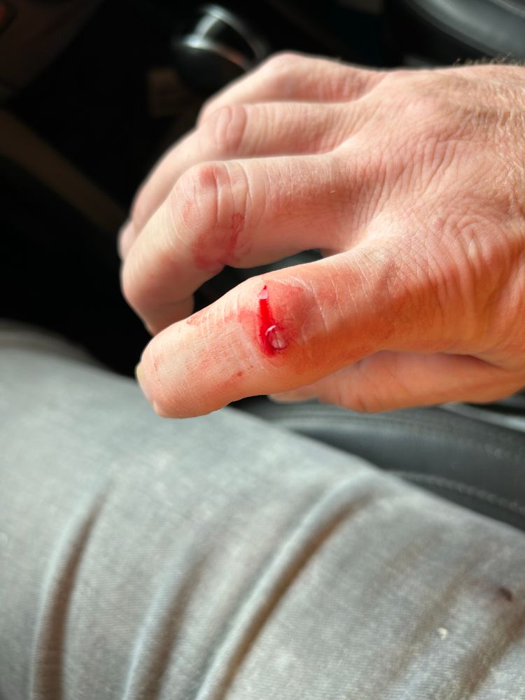 Bloody index finger knuckle 