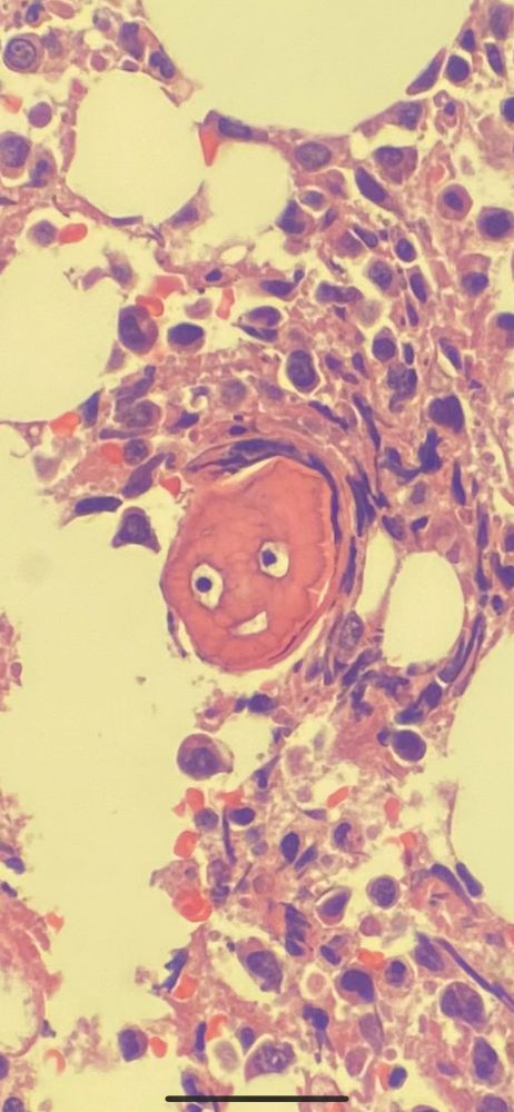 A histological image from a bone marrow biopsy with a small fragment of bone that looks like the beloved Disney character, Nemo. 
