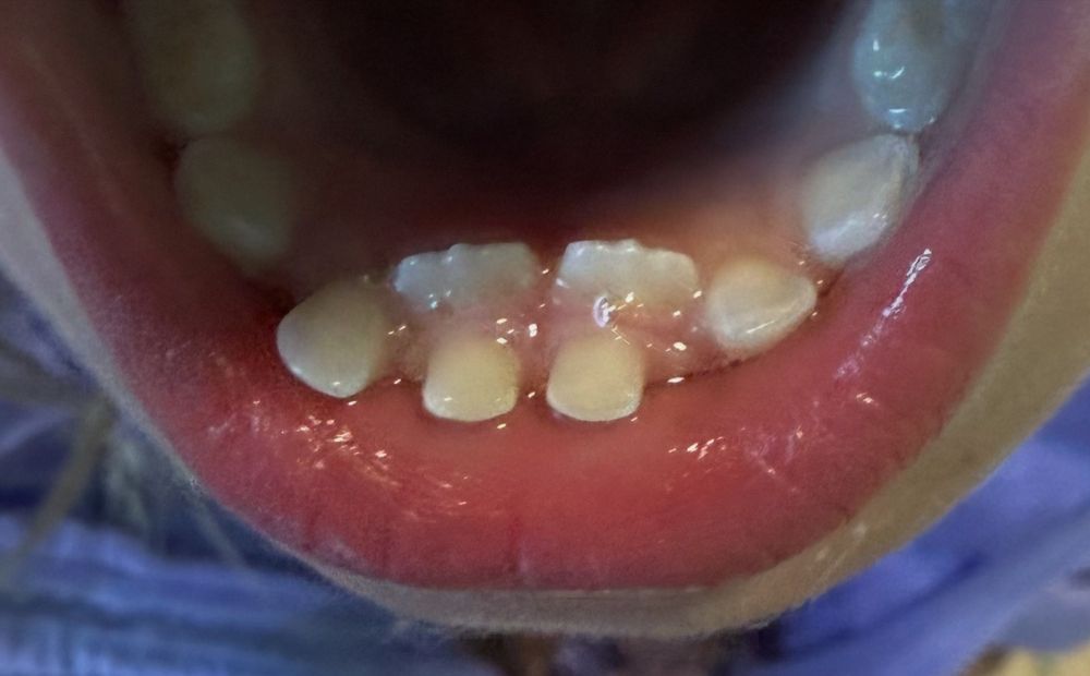 the bottom row of a child’s teeth, but the front two teeth have two teeth behind them