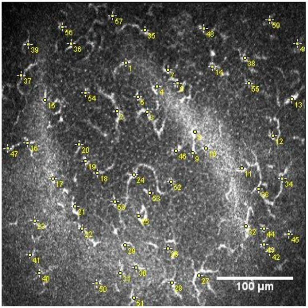 Neuroinflammatory Findings of Corneal Confocal Microscopy in Long COVID-19 Patients, 2 Years after A...