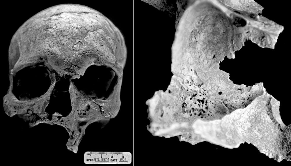 Bronze Age leprosy hitched rides along ancient copper and pottery trade route