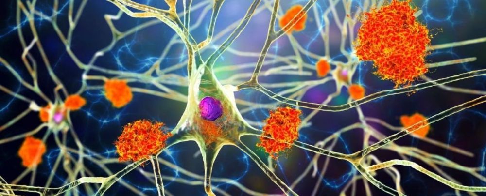 Study of 500,000 Medical Records Links Viruses With Alzheimer's Again And Again