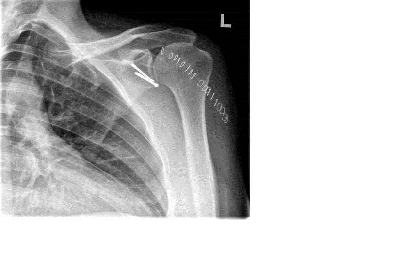 X-ray image of left shoulder with two screws holding socket together. Staples that closed the incision are visible as well.