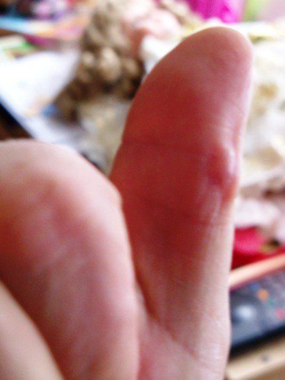 thumb with weird bump, which is actually an amputated supernumerary digit