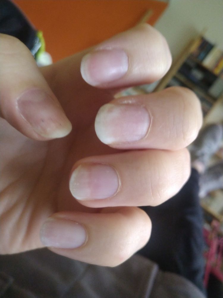 photo from last week, removed all the gel nail polish for surgery.