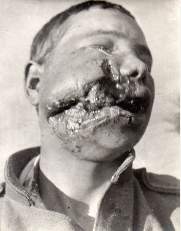 This is the image of a wounded soldier from WWI which I shared, and about which the General complained. It IS gruesome. However, I say that such gruesome photos MUST be seen, because this is the reality of imperialist war - not the lies and patriotic filth spouted by the commander of the Canadian Army, Lt. General Michael Wright. 