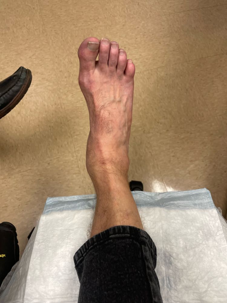 My ankle and foot swollen