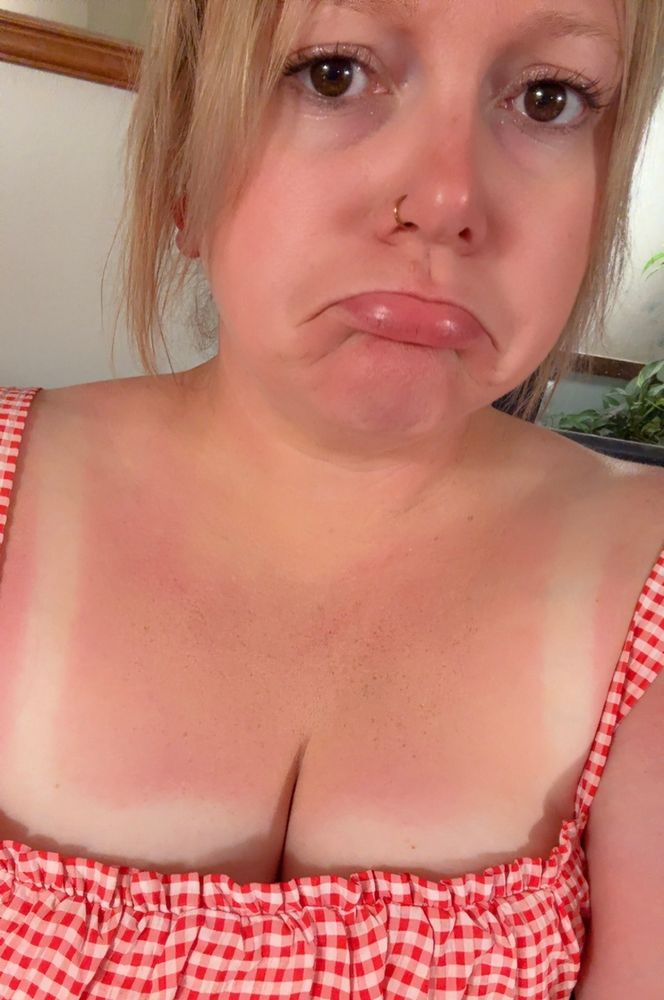 Got a little sunburn 