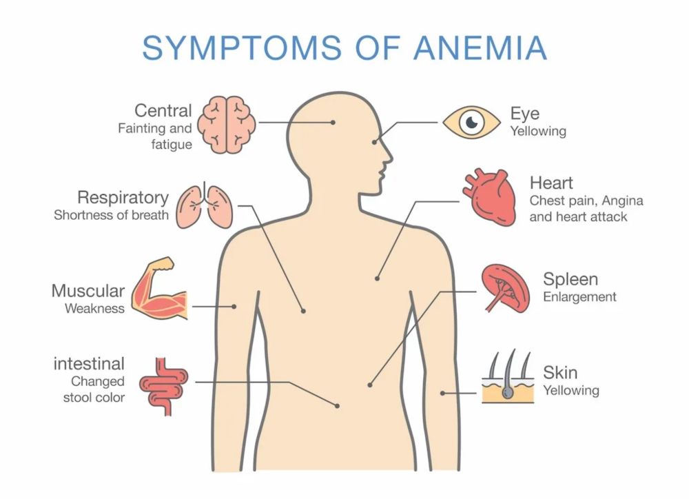 Anemia in elderly causes, Myelodysplastic syndromes, Anemia of chronic disease and inflammation - Science online