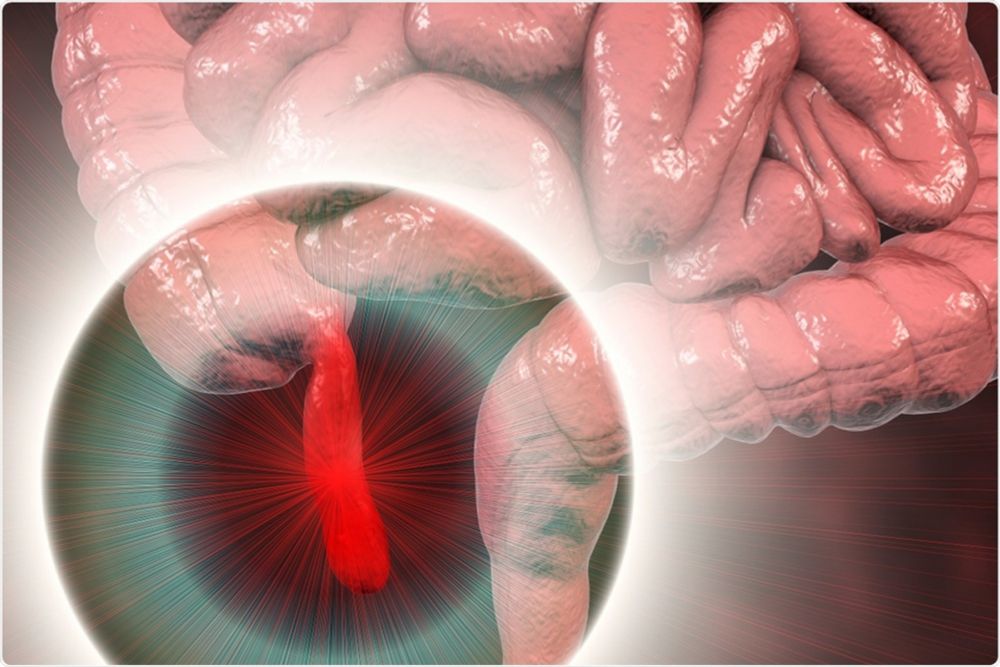 COVID-19 may be linked to acute appendicitis in children