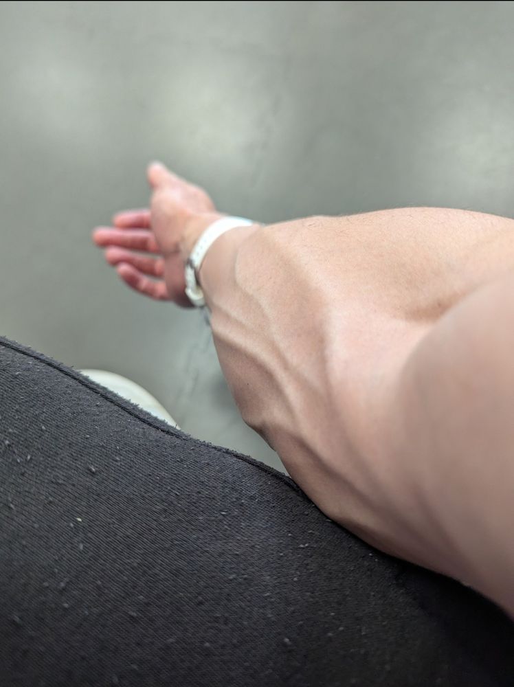 Foreshortened shot of my arm with a swollen spiderweb of veins casting down from the bicep over the forearm, to the tiny tiny hand in the distance. My hand is not actually tiny tho it is just an effect of the photographic lens on my mobile phone. The nitrile gloves I wear in the lab are medium size so I guess I have medium size man hands.