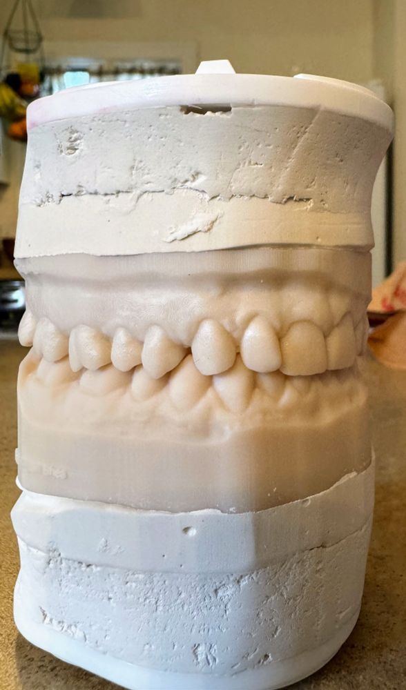 Plaster cast of my teeth.