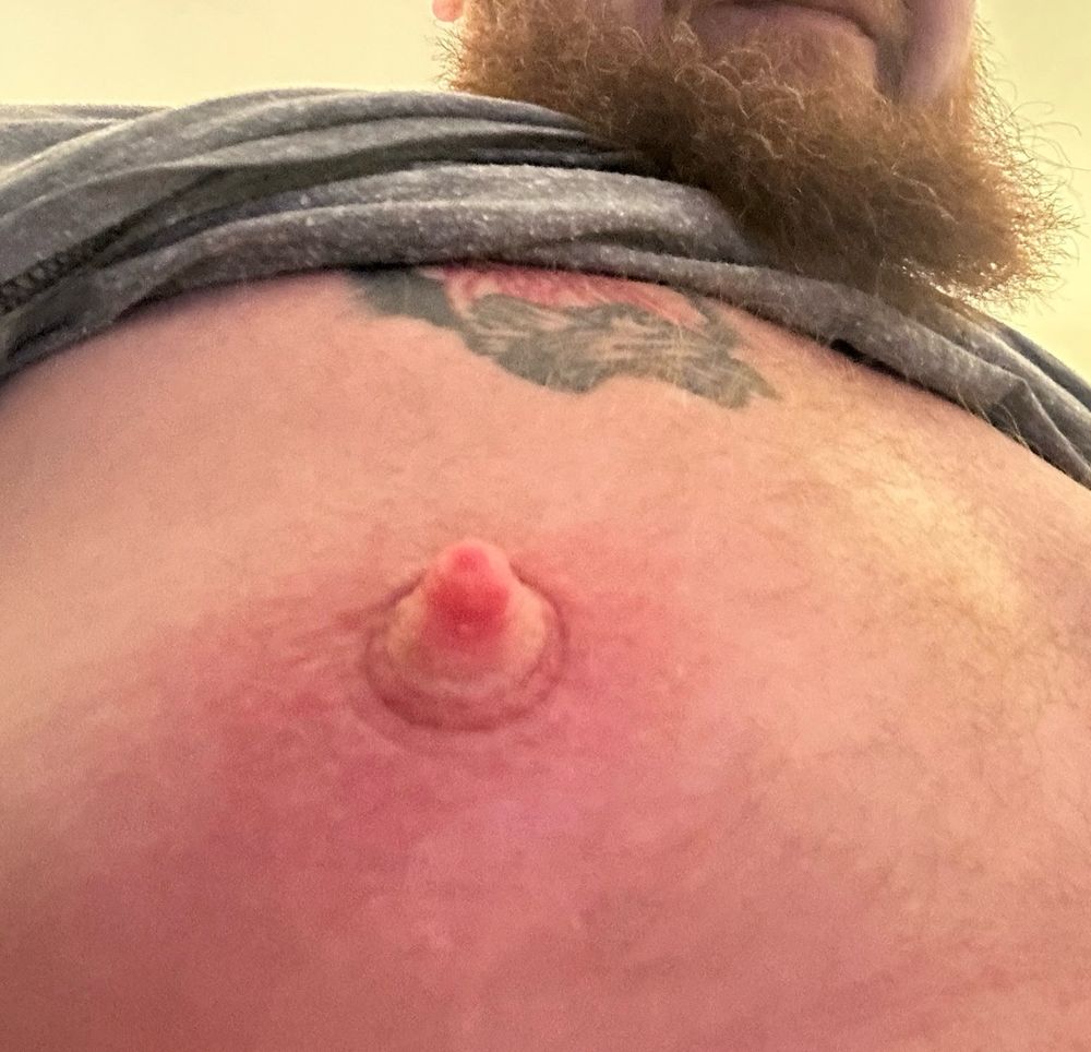 Picture shows the engorged nipple (with a sucker mark) of a bearded man.