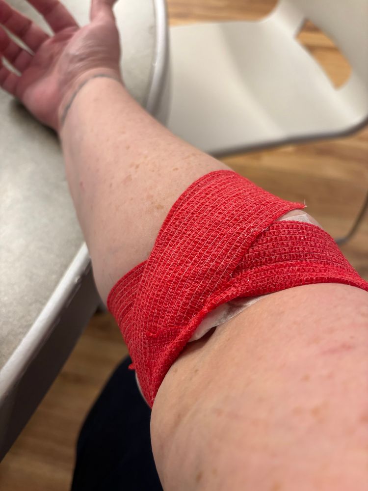 A picture of my arm (pale with freckles), the elbow wrapped in red bandage tape with a white bandage peeking out from under. 
