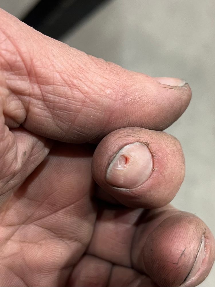 Another shot with my fingers curled over showing there’s still a bit of nail connected at the edge of the hole near the tip of my finger 