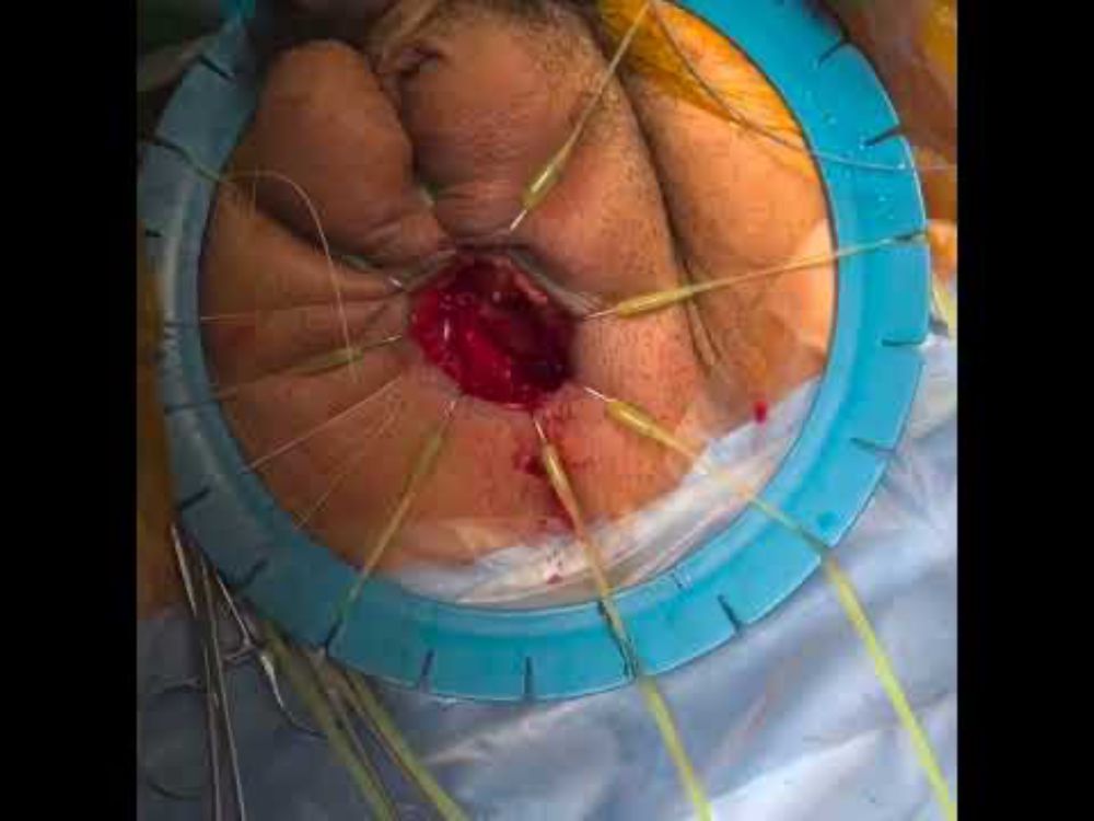 Dorsal onlay urethroplasty with buccal mucosa graft, uncut 50 mins, recorded with Apple Vision Pro